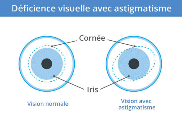 Astigmatisme