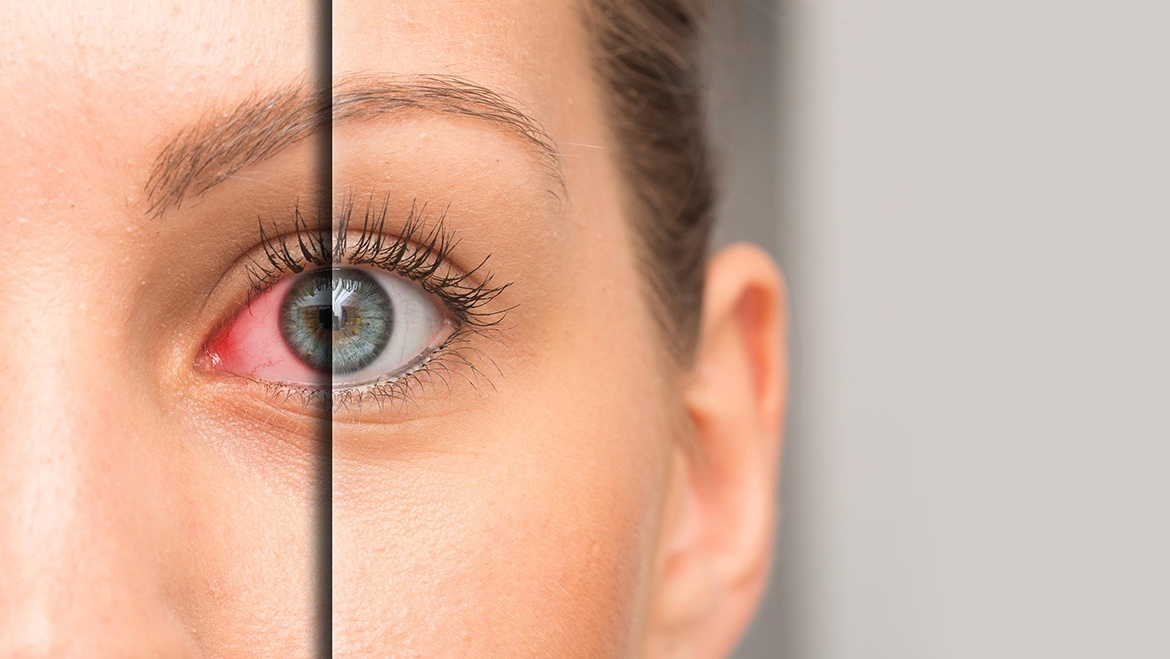 Quelles sont les meilleures lentilles de contact pour les yeux secs